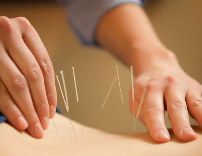 Иглорефлексотерапия - Санаторий «Буг» Беларусь Иглорефлексотерапия - Санаторий «Буг» Беларусь